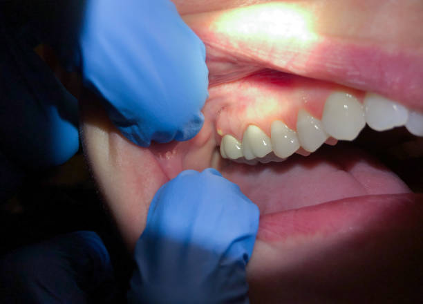 Best Emergency Dental Extractions in Syosset, NY